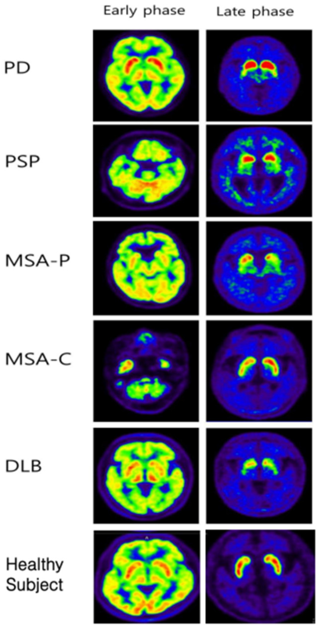 Representative images of early and late phases 18F-FP-CIT PET/CT from PD, PSP, MSA-P, MSA-C, and DLB patients. In the late phase, even in APDs such as DLB, a rostocaudal gradient was observed, and in MSA-C patients, the asymmetric index was increased. In other words, it can be said that it is difficult to differentiate between PD and APS using only the late phase image.