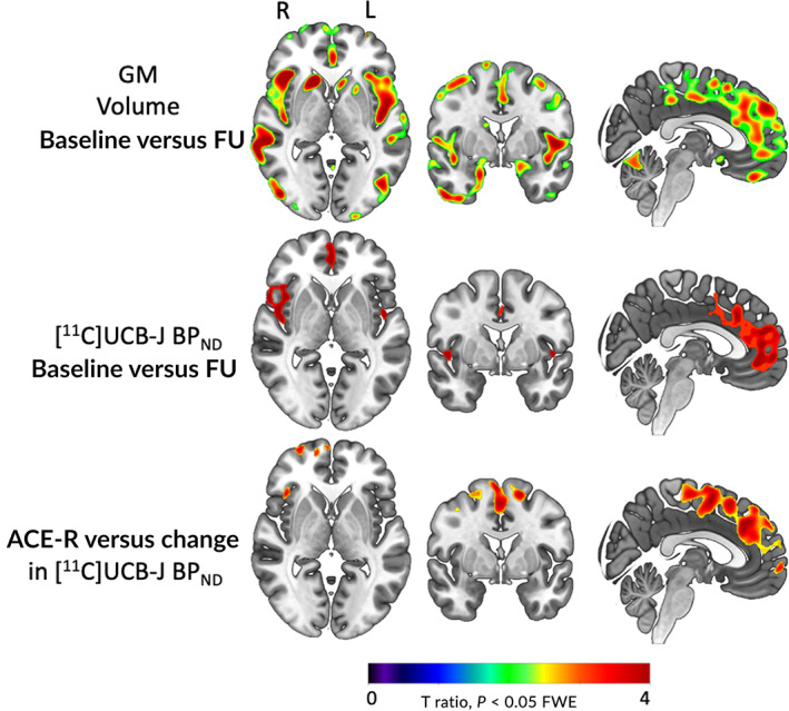 Voxelwise t‐ratio brain maps illustrating longitudinal change in gray matter volume and [11C]UCB‐J BPND, and a significant relationship between reduced [11C]UCB‐J BPND and worse performance on the Addenbrooke's Cognitive Examination–Revised (ACE‐R) (P < 0.05 FWE corrected). FU, follow‐up; GM, gray matter. [Color figure can be viewed at wileyonlinelibrary.com]