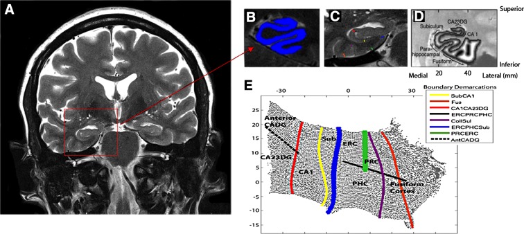 High-resolution hippocampal image processing and thickness calculations. (A) The goal of high-resolution hippocampal image processing is to isolate the strip of gray matter in the MTL that encompasses the subregions of the hippocampus proper and surrounding neocortex, shown in (B) in blue. This is done by manually segmenting cerebrospinal fluid and white matter and growing sequential layers of gray matter from the edge of white matter until the layer reach the cerebrospinal fluid boundary. (C) The boundaries between MTL subregions are marked according to anatomical landmarks. Because of limits in resolution in CA fields 2, 3, and DG we treat these regions as a single entity (CA23DG). Demarcations shown here include CA fields 2, 3, and the dentate gyrus (CA23DG) | CA1 (red), CA1 | subiculum (Sub; yellow), PHC | Sub (blue), fusiform gyrus (Fus; orange), Collateral sulcus (CollSul; purple) and PRC (green). (D) Boundary delineations were projected to their corresponding coordinates in flat map space. Each subregion is considered separately for cortical thickness calculations. Cortical thickness is visualized in in-plane space as a grayscale map of thickness values between maximum (white) and minimum (black) values. (E) To extract thickness, the distance from each voxel in in-plane space to the nearest nongray matter voxel was calculated. Next, the maximum distance value of two-dimensional voxels for the corresponding three-dimensional voxels across all layers was taken and multiplied by two to calculate mean thickness. Demarcations were projected from in-plane space to the corresponding location in 2D flat map space and then extended to form complete and smooth boundaries between subregions. CA1, cornu ammonis 1; ERC, entorhinal cortex; PHC, parahippocampal cortex; PRC, perirhinal cortex; MTL, medial temporal lobe.