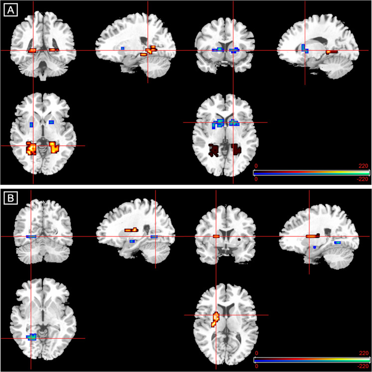 Altered brain activation in participants at clinical high risk of psychosis (CHR) and effect of cannabidiol (CBD).a Fear processing in the CHR-placebo vs control group. Clusters showing greater (red/yellow) or reduced (blue/green) activation in participants at clinical high risk receiving placebo compared with healthy controls during fear processing. b Fear processing in the CHR-CBD vs CHR-placebo group. Clusters showing greater (red/yellow) or reduced (blue/green) activation in participants at clinical high risk receiving cannabidiol (CBD) compared with those receiving placebo during fear processing. The right side of the brain is shown on the right of the images.
