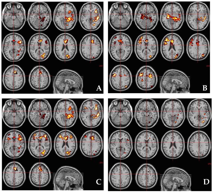 (A) Regions of brain activation showing significantly greater correlation with the number of A alleles of the AKT1 rs1130233 polymorphism under THC condition than under placebo condition while viewing fearful faces. The left side of the brain is shown on the left side of the image. (B) Regions of brain activation showing significantly greater correlation with methylation percentage at CpG island 11–12 around rs1130233 polymorphism in the AKT1 gene under THC condition than under placebo condition while viewing fearful faces. The left side of the brain is shown on the left side of the image. (C) Regions of brain activation showing significantly greater correlation with the number of A alleles of the AKT1 rs1130233 polymorphism under THC condition than under placebo condition while viewing fearful faces after controlling for percentage methylation at CpG island 11–12 around rs1130233 polymorphism in the AKT1 gene. The left side of the brain is shown on the left side of the image. (D) Clusters of brain activation where the significantly greater correlation between the number of A alleles of the AKT1 rs1130233 polymorphism under THC condition than under placebo condition while viewing fearful faces may be mediated by correlation with methylation percentage at CpG island 11–12 around rs1130233 polymorphism in the AKT1 gene. The left side of the brain is shown on the left side of the image.