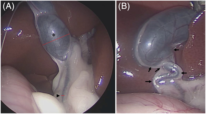 Dilatation of the cystic duct (CD) was measured as follows. With the CD and common bile duct (CBD) visible simultaneously in a single endoscopic image, we calculated the ratio between the width of the thickest part (dotted line) of the CD (*) and the width of the thinnest part (solid line) of the CBD (arrowhead; CD/CBD). For example, in the image of the biliary system of the case in (A), the width of the CD using the scale on the image is 2.94 and the width of the common bile duct is 0.32, implying that the dilatation is 9.18‐fold. In addition, the number of tortuous turns was obtained by adding the total number of places where the biliary tract from the CD to the common bile duct tortuous turns by ≥90° (arrow). Therefore, the total number of tortuous turns in the case in (B) is 5