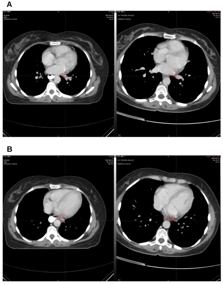 On the left, CT from October 2019, pre-radiation therapy treatment; on the right, CT from August 2021. (A) Hilar lymph node; (B) left para-aortic lymph node. The indicated region highlights the boundary of the treated target.