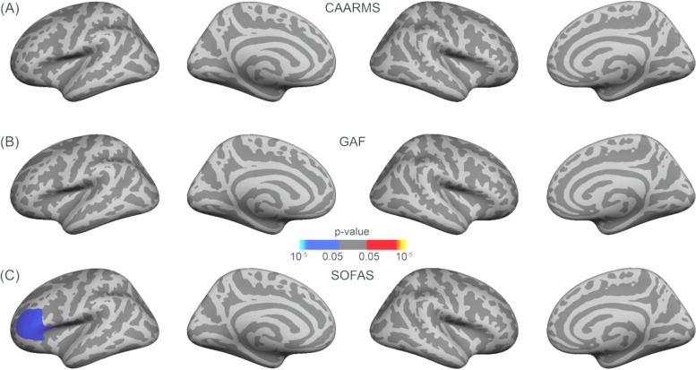 Corrected correlation maps between surface area with nuisance variable intracranial volume and (A) CAARMS, B GAF and C SOFAS scores for the ARMS cohort. A frontal–temporal mask was used, and multiple comparison correction was performed using permutation testing of 100,000 tests with a cluster-forming threshold of p < .05 and cluster-wise threshold of p < .05 with an additional Bonferroni correction to take both hemispheres into account. (Blue = negative correlation between surface area and SOFAS scores)