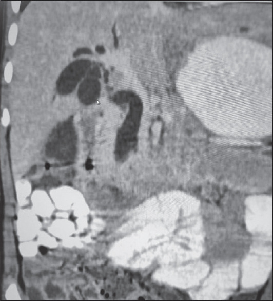 Magnetic resonance cholangiopancreatography showing double gall bladder and dilated common bile duct