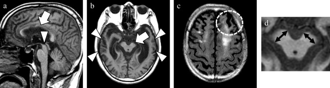 A representative case of CBD mimics. This 74-year-old male patient obtained a postmortem diagnosis of FTLD-TDP. MRI was performed three years after the symptom onset. The confusable atrophy of the midbrain and callosal body (arrow and arrowhead, a), asymmetric atrophy of the left cerebral peduncle (arrow, b) and frontal lobe, and SWMH in the left frontal lobe at high convexity (circle, c) were detected. The severity of bilateral temporal lobe atrophy (arrowheads, b) significantly differed from that of CBD. This patient was exhibited to clarify the different atrophy patterns in the CBD mimics group, especially the non-PSP subgroup. A magnified view was exhibited to emphasize the asymmetry of the short axis in the cerebral peduncles (double sided arrows, d). a, sagittal T1WI; b, axial T1WI; c, axial FLAIR image; CBD, corticobasal degeneration; FLAIR, fluid attenuated inversion recovery; FTLD-TDP, frontotemporal lobar degeneration with TAR DNA-binding protein of 43 kDa; SWMH, subcortical white matter hyperintensity; T1WI, T1-weighted image