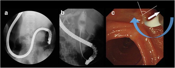a, b The endoscope rotate in 180° counterclockwise in the stomach, and shortened by again rotating 180° to the counterclockwise in the duodenum. c In the endoscopic view, the ampulla was deviated to the right and right-sided direction The bile duct direction (white arrow), catheter device direction (blue arrow), and angle between two vectors (white line) are indicated