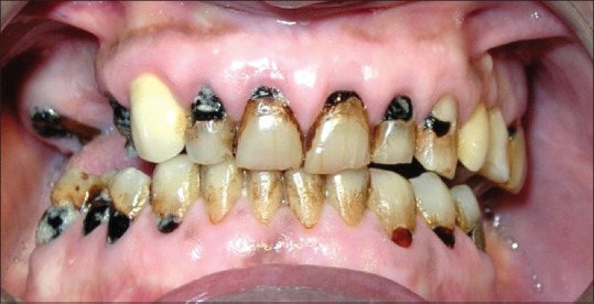 Generalized cervical caries in a 33-year-old patient inhaled burnt heroin fumes for 9 years