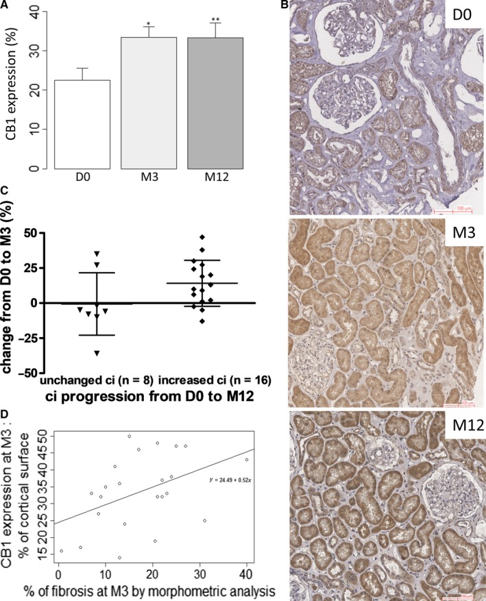 Cannabinoid receptor 1 expression is induced during CAD and correlates with renal fibrosis. A, Quantification of CB1 expression by a morphometry software (Calopix, Tribvn). *P < .05 and **P < .05 compared to D0. Means ± standard deviation. B, Illustrative case of CB1 expression at D0, M3 and M12 revealed by peroxidase immunohistochemistry. The biopsies were performed in a 68‐y‐old woman who received a kidney graft from an extended criteria donor. Preimplantation biopsy was normal according to Banff classification, with IF/TA grade 0. Creatininemia at organ removal was 89 µmol/L. From M3, graft biopsies exhibited IF/TA grade 1 according to the Banff classification, without other changes. At M3 and M12, creatininemia were, respectively, at 155 µmol/L and 122 µmol/L. Her immunosuppressive regimen included prednisone, mycophenolate mofetil and tacrolimus (T0 3.2 ng/mL at M3 and 4.3 ng/mL at M12). Quantification of CB1 expression by a morphometry software was 21% at D0, 48% at M3 and 57% at M12. C, Patients with unchanged ci from D0 to M12 tended to have less CB1 progression evaluated by a morphometry software (Calopix, Tribvn) (−0.62 ± 7.8 vs 14.1% ± 4.1%, P = .08). D, Correlation between CB1 expression and renal fibrosis assessed by morphometry software (Calopix, Tribvn) at M3 (n = 26, NA = 3, Pearson correlation test, P = .04, R = .44). Abbreviations: CAD, chronic allograft dysfunction; D0, day 0; IF/TA, interstitial fibrosis and tubular atrophy; M3, month 3; M12, month 12