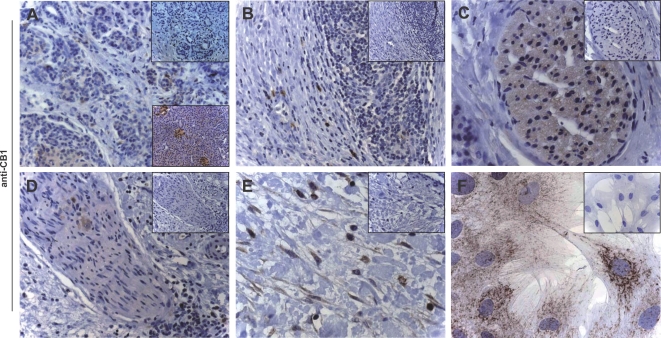 Cannabinoid receptor 1 in human chronic pancreatitis tissues.CB1 immunohistochemistry: staining of tubular complexes (A) but immunonegativity of infiltrating mononuclear cells (B); various staining intensities of intrapancreatic nerves (C&D); pancreatic stellate cells in areas of fibrosis (E) or isolated and cultured in vitro (F). Original magnification: x20 (A, B, D), x40 (C), x80 (F). Insets: negative controls. Lower insets (A): CB1 in normal pancreas.