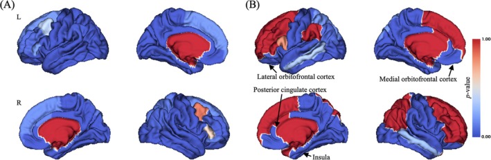 Brain pattern of time point main effect on CT. (A) Uncorrected p value distribution for time point main effect on CT; (B) Bonferroni correction of p value distribution for time point main effect on CT. L, left; R, right. The colour bar represented p value of time point main effect on CT.