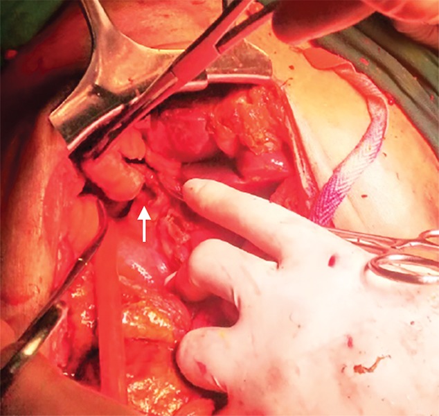 Perforation in CBD