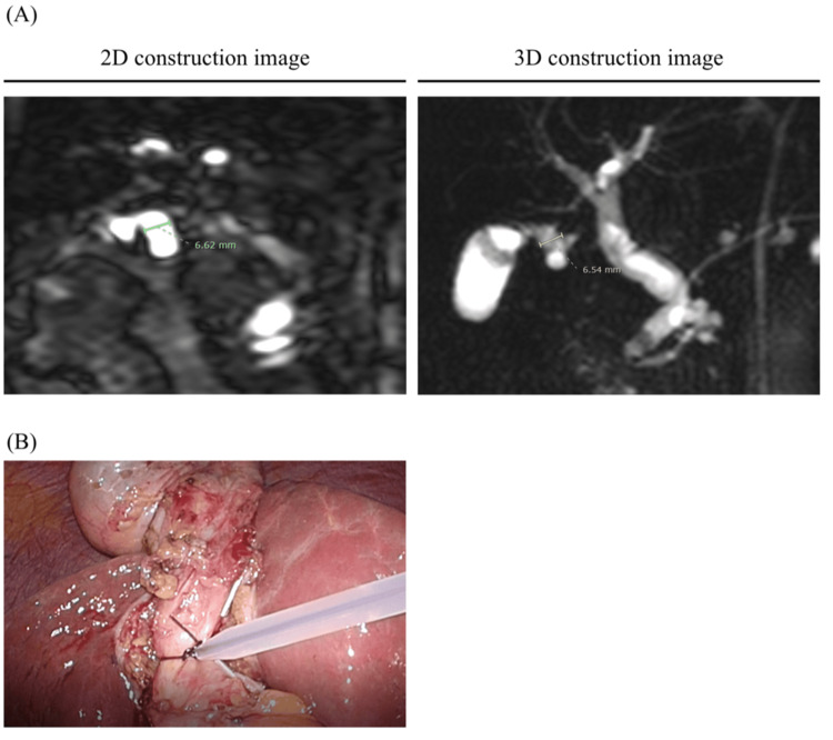 Magnetic resonance cholangiopancreatography (MRCP_ images.(A) The diameters of the cystic duct were represented in both two- and three-dimensional construction images via MRCP. (B) Intraoperative images from laparoscopic cholecystectomy of patients with the MRCP image above.