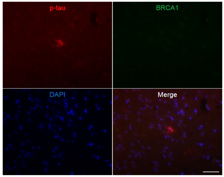 Immunofluorescence double staining of progressive supranuclear palsy frontal lobe. p-tau positive tuft-shaped astrocytes were mostly immunonegative for BRCA1 as represented in this figure. The scale bar represents 50 µm.