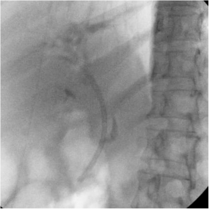 A fluoroscopic image after the stent exchange showing the new stent in place.