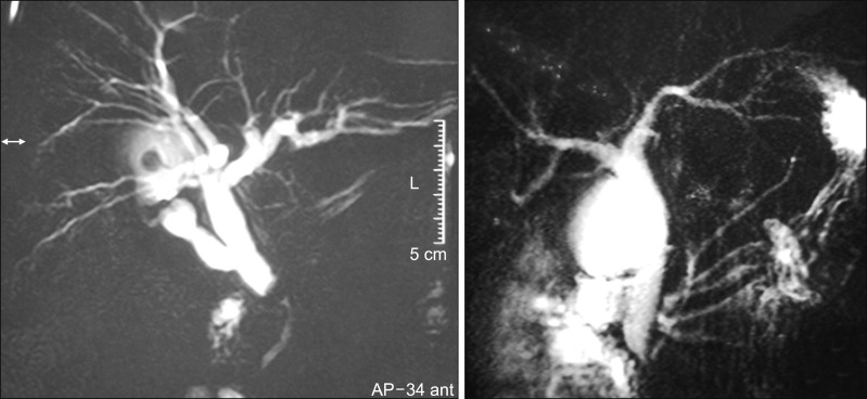 MRCP to show type I (left) and type II (right) Calot's anatomy. Note the presence of cystic duct in type IA. This patient had concomitant choledocholithiasis.
