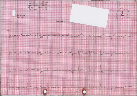 Electrocardiogram 4 h post-presentation, with recurrence of chest pain showing ST-elevation in leads V1-V2