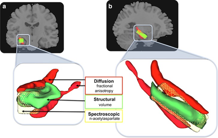 Multimodal assay of the medial temporal grey matter and white matter, and biochemistry. (a) Coronal view; (b) sagittal view. Concurrent (within subjects) assay of fractional anisotropy from the fimbria and cingulum–hippocampus white-matter fibres (red); anatomical grey-matter volume of the hippocampus proper (green); and N-acetylaspartate from a voxel positioned over the hippocampus (yellow). Lower panels show a close-up rendered image to illustrate the relative positions and associations of the medial temporal regions assayed.