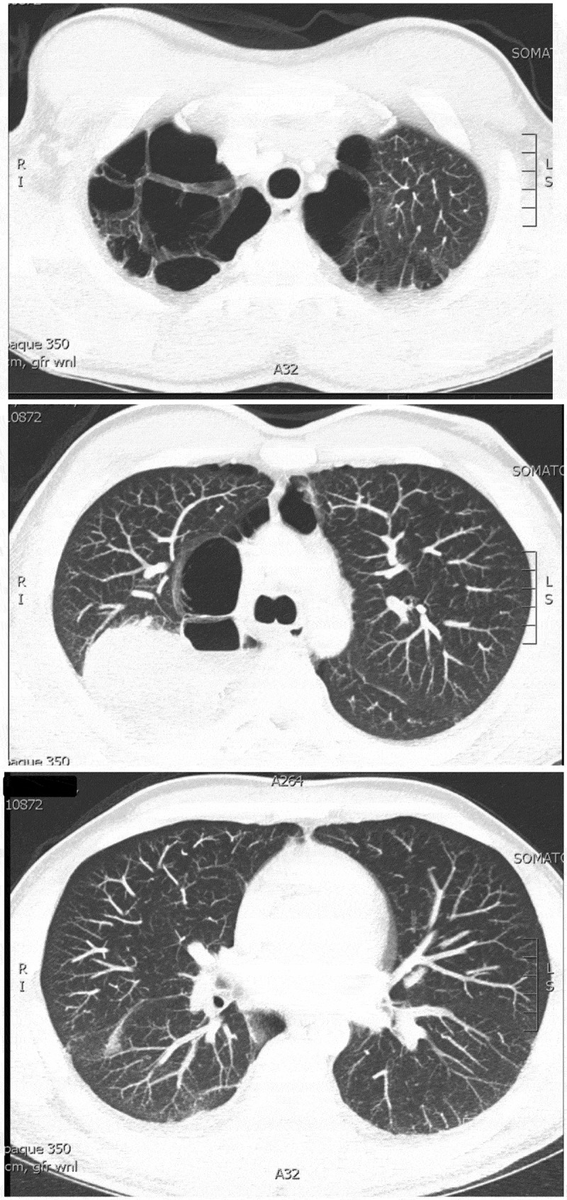 CT chest with contrast.