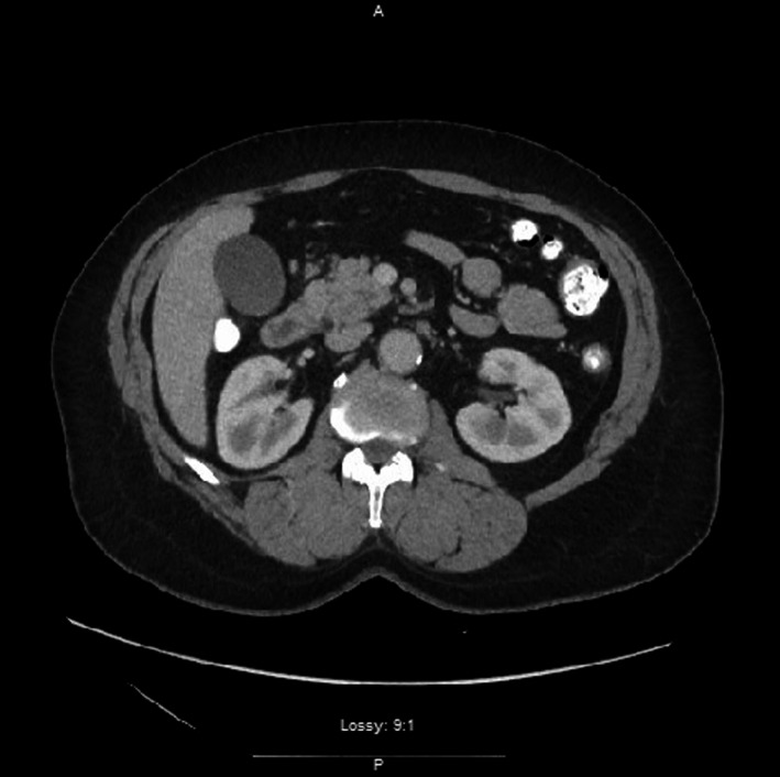 CT Abdomen & Pelvis with contrast demonstrating inflammation surrounding the middle portion of the duodenum and head of the pancreas suggesting acute pancreatitis. (Axial View)