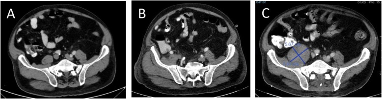 Psoas abscess development on consecutive double contrast abdominal computed tomography scans. Scans were done on days 3 (a) 7 (b) and 26 (c) post- endoscopic retrograde cholangiopancreatography ERCP