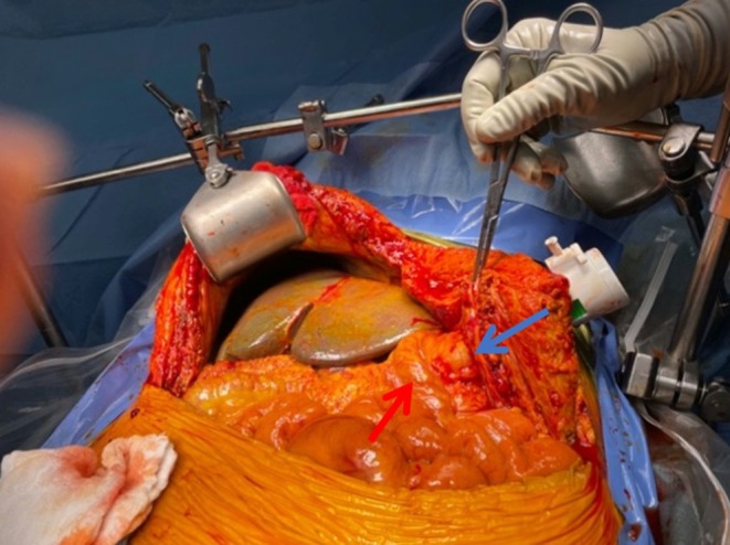 Reopening of the recent transplant incision to access the gastric remnant, positioned away from the recently reconstructed portal triad. A 15 mm trocar is inserted into the remnant stomach (blue arrow), lateral to the Roux limb (red arrow), to optimize endoscope placement. The gastric remnant is secured to the abdominal wall. Red arrow, roux limb. Blue arrow, trocar entering remnant stomach.