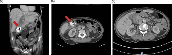 Contrast‐enhanced CT images demonstrating the cholecystocolonic fistula and associated choledocholithiasis. (a) Coronal and (b) axial images show a large peripherally calcified gallstone within the hepatic flexure, immediately adjacent to the collapsed, thick‐walled gallbladder fundus, with surrounding inflammatory change and intraluminal gas. (c) Axial image shows an ~11 mm calculus impacted in the distal common bile duct (calipers), with upstream biliary dilatation.
