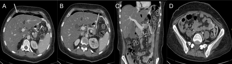 (A) Axial view of the computed tomography (CT) of the abdomen and pelvis demonstrating the gastric wall defect (white arrow head) with leakage of air into the peritoneum and associated pneumoperitoneum in the perihepatic space (white arrow). (B) Axial and (C) coronal CT of the abdomen and pelvis with oral contrast demonstrating contrast leak (white arrow) along the gastric wall defect into the peritoneal space. (D) Axial CT of the abdomen and pelvis demonstrating a leaked contrast material in the pelvis.