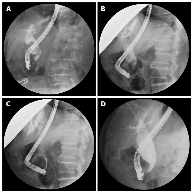 Common bile duct stone clearance was assessed after each endoscopic retrograde cholangiopancreatography session using procedure reports, plain ﬁlms, endoscopic retrograde cholangiopancreatography ﬁlms and/or abdominal magnetic resonance cholangiopancreatography. A: Pre-ESWL large common bile duct stones were very large; B: Post-ESWL reduction in diameter of CBD stones; C: Stones were tracked by a basket during the following ERCP; D: CBD was cleared successfully. ESWT: Extracorporeal shockwave lithotripsy; ERCP: Endoscopic retrograde cholangiopancreatography; CBD: Common bile duct.