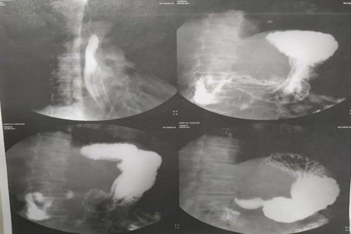 Upper GI series reported no evidence of fistula
