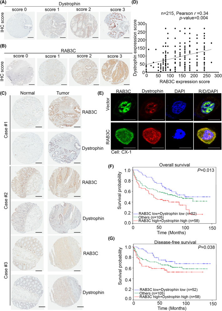 Combined RAB3C and dystrophin serve as an independent indicator of poor prognosis, distant metastasis, and advanced stage in CRC patients. (A) Scores indicating dystrophin levels in representative colorectal tumor tissues from 0 to 3. Scale bar: 300 μm. (B) Scores indicating RAB3C levels in representative colorectal tumor tissues from 0 to 3. Scale bar: 300 μm. (C) Representative image of dystrophin/RAB3C‐protein‐staining results in normal adjacent tissue/tumor pairs of patients. Scale bar: 300 μm. (D) Correlation statistics between RAB3C and dystrophin protein in CRC tissue microarray (n = 215; Pearson's r = 0.34; P = 0.004). (E) Representative fluorescent images of dystrophin/RAB3C‐protein‐staining results in RAB3C‐expression model in CX‐1 cells. Scale bar: 10 μm. (F) Kaplan–Meier curves of overall and (G) disease‐free survival of 215 patients with CRC, stratified by high or low RAB3C, combined with dystrophin protein expression levels (P = 0.013 and P = 0.038, respectively). “Others” include RAB3C high + dystrophin low group and RAB3C low + dystrophin high group. All experiments were performed with at least three biological duplicates (n = 3) for each group, in triplicate.