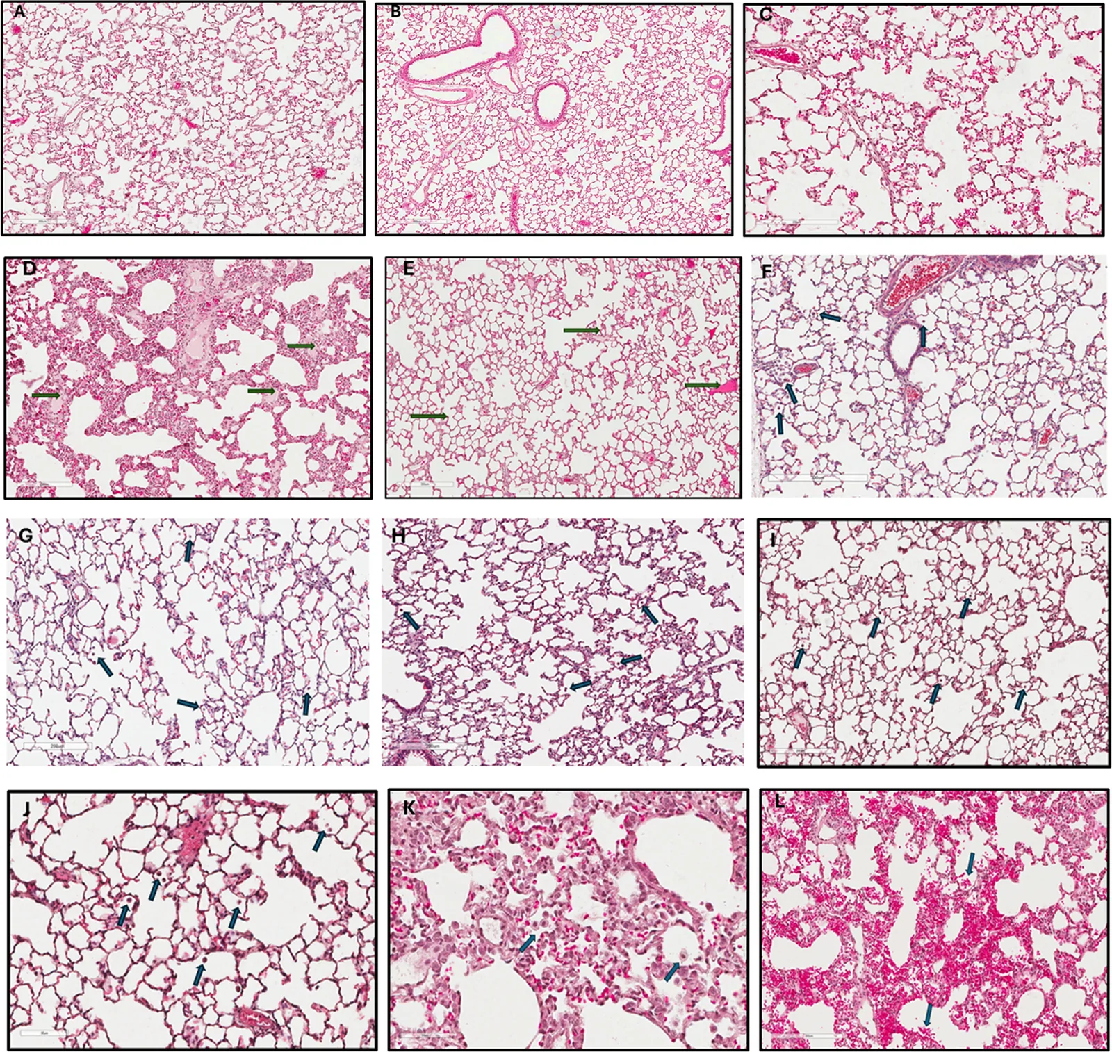 Lung histology via H&E staining from Sham and CCI rats. A & B Sham-operated rats exhibited histologically normal lung structure, characterized by intact bronchioles, arteries, capillaries, alveoli, and veins. Magnification: 10x; Scale bars in (A) = 200 µm and (B) = 300 µm. C-E CCI rats revealed thickening of the alveolar walls, RBCs in alveoli, and hyaline material (green arrows). Magnification: 20x; Scale bars in (C + D) = 200 µm and (E) = 300 µm. F–H H&E staining of lung tissue from CCI rats treated with PGVG vapor vehicle for two weeks. Lung tissue showed enlarged alveoli, presence of alveolar macrophages (green arrows), and (H) thickened alveolar walls. Magnification: 20x; Scale bars in (F) = 300 µm and (G + H) = 200 µm. I-L H&E staining of lung tissue from CCI rats treated with CBD vapor for two weeks. Lung tissue showed (I-L) enlarged alveoli, J-L thickened alveolar walls, I-K presence of alveolar macrophages (green arrows), and (L) RBCs in alveoli (arrows). Magnification in (I) = 20x, in (J-L) = 40x; Scale bars in (I + L) = 200 µm, J = 80 µm, and K = 60 µm