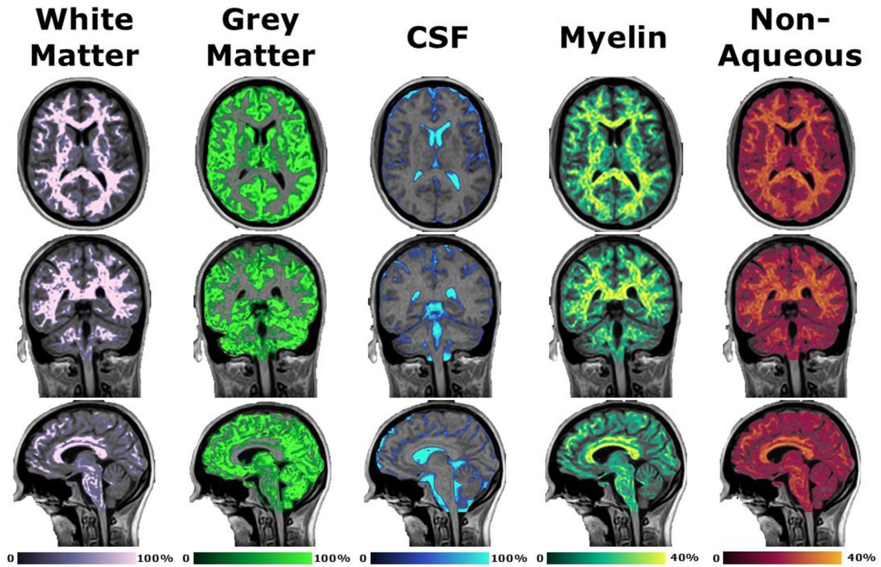 Demonstration of post-processing available from SyMRI combined with 3D-QALAS at high isotropic resolution in a healthy volunteer. Shown from left to right are the white matter, grey matter, cerebrospinal fluid, myelin, and non-aqueous component synthetic images in the axial (top), coronal (middle), and sagittal (bottom) orientations overlayed onto the synthetic T1-weighted image.