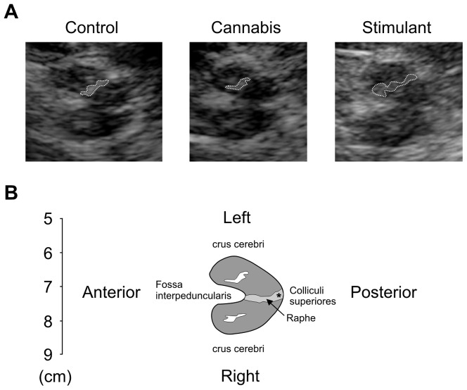 Single subject data showing echomorphology of the mesencephalic brainstem.A) Images from 1 control subject, 1 cannabis subject, and 1 stimulant subject. The substantia nigra ipsilateral to the probe (the side at which the planimetric measurement is done) is encircled with a dotted line. B) Schematic drawing of the mesencephalic brainstem. * aqueduct. Raphe, echogenicity of midline structures.