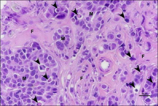 Histopathology of adenocarcinoma tumor nodules (M) from mice subcutaneously injected with Michigan Cancer Foundation-7 breast cancer cell line and treated with cannabinoid extract revealed apoptotic tumor cells (arrows). The tumors predominantly exhibited a lobular growth pattern, with individual lobules separated by fibrous connective tissue (F). Sections were stained with hematoxylin and eosin (H&E) and examined at 40× magnification.