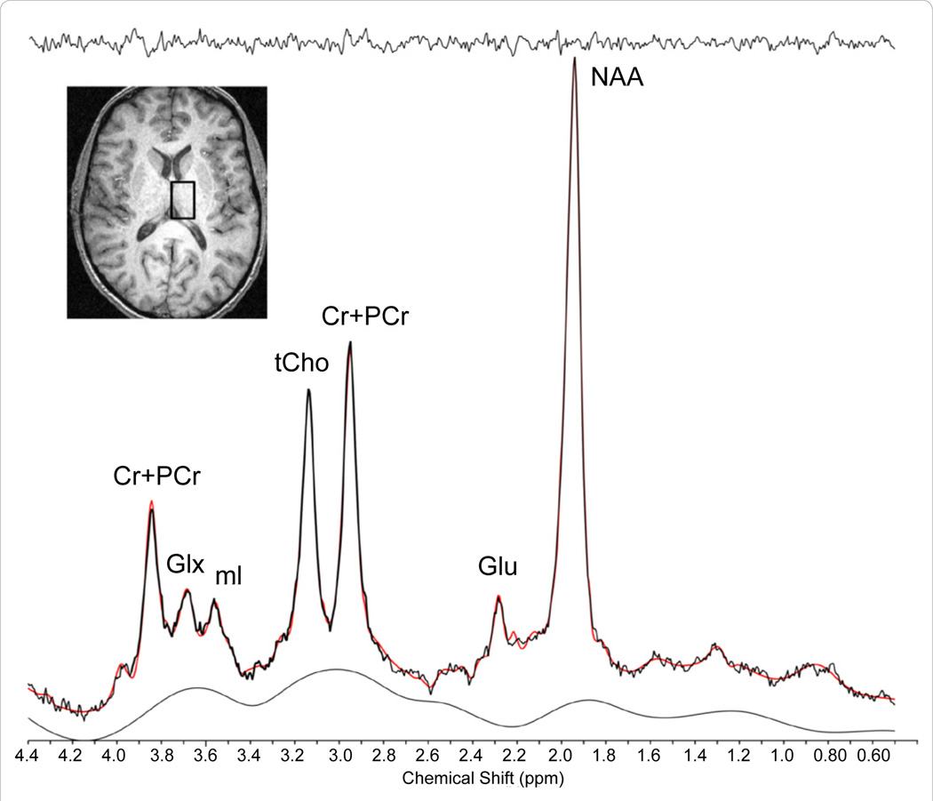 Sample Single Voxel Thalamic 1H Spectrum. Axial anatomical image illustrating the placement of a single voxel (2 × 2 × 3cm) in the right thalamus of a healthy subject acquired at 4.0 Tesla using 2D-JPRESS, and the associated 1H spectrum (below). Abbreviations: tCr (Cr + PCr), total creatine; Glx, glutamine/glutamine/GABA complex; ml, myo-inositol; tCho, total choline; Glu, glutamate; NAA, N-acetylaspartate.