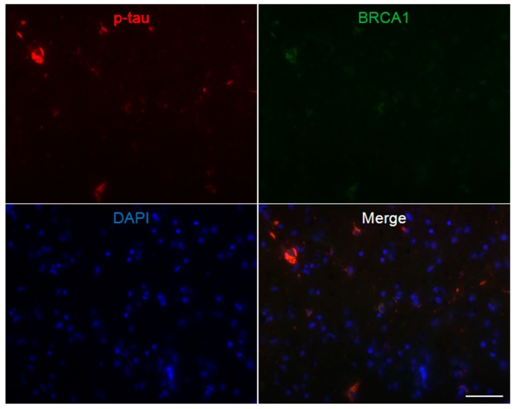Immunofluorescence double staining of progressive supranuclear palsy midbrain. Multiple p-tau positive globose neurofibrillary tangles are seen, which mostly show colocalization of BRCA1. The scale bar represents 50 µm.