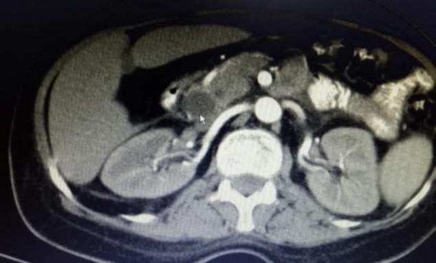 The axial cut of the intravenously and orally-enhanced abdominopelvic CT scan of the patient