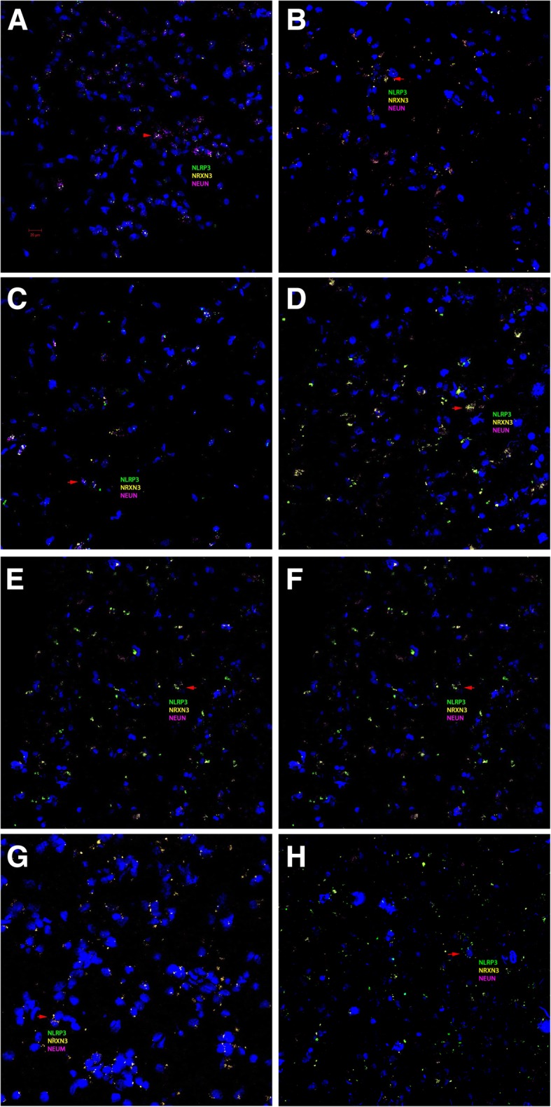 a–h RNAscope in situ hybridization of control and AD brain samples with different Braak numbers Green represents NLRP3, yellow NRXN3, and magenta NEUN. The red arrow indicates colocalization of three probes in the same cell. H-score correlations of NRXN3 and NLRP3 intensities with Braak numbers. (a) MTG-Braak 0; (b) MTG-Braak 1; (c) MTG-Braak 2; (d) MTG-Braak 4; (e) MTG-Braak 5; (f) MTG-Braak 6; (g) HIP-Braak 0; (h) HIP-Braak 6