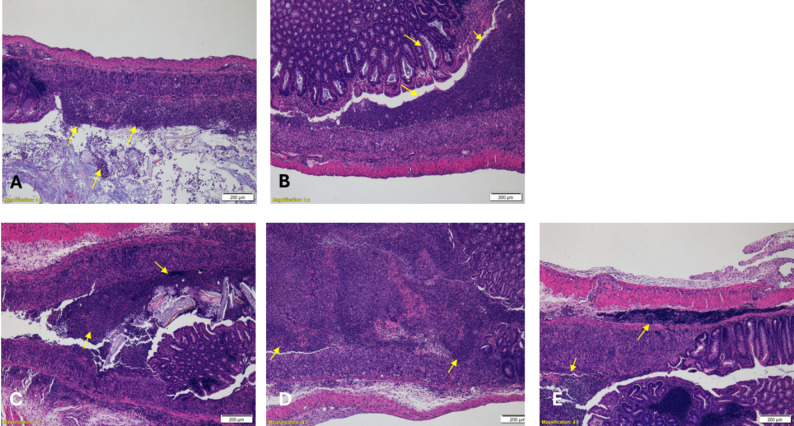 Representative histopathological micrographs of distal colon sections from DSS-induced colitis mice. Hematoxylin and eosin (H&E)–stained sections illustrating colonic mucosal architecture and inflammatory changes across treatment groups: A Saline control, Severe ulceration of large parts of the mucosa, erosion and crypt loss with many cellular debris in the gut lumen. Inflammatory reaction around and within the lesions is shown (arrows); B Hyaluronic acid (HA) vehicle control, Severe erosion of large parts of the mucosa. Inflammatory reaction within the lesions is shown (arrows); C Cannabidiol (CBD), Severe ulceration of large parts of the mucosa, partial erosion and crypt loss. Note inflammatory reaction around and within the lesions (arrows); D Sodium propionate (Na-P), Severe ulceration of large parts of the mucosa, partial erosion and crypt loss. Note inflammatory reaction within the lesions (arrows); E CBD + Na-P combination therapy, Moderate ulceration of the mucosa, erosion and crypt loss. Inflammatory reaction around and within the lesions is shown (arrows). Images are representative of blinded histopathological evaluations and correspond to semi-quantitative scoring data. Original magnification ×4