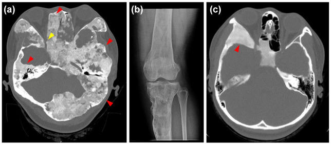 Radiologic imaging of fibrous dysplastic bone. (a) Craniofacial CT scan of a 33-year-old female with FD/MAS, showing extensive fibrous dysplastic bone in the skull (representative lesions, red arrows). Narrowing of the optic canal can be seen in this image (yellow arrow). In addition, this craniofacial lesion shows cystic changes that can be seen in some FD lesions. (b) FD of the right tibia as seen on plain film X-ray, of the same patient at age 29. (c) FD of the craniofacial region in a 16-year-old female, showing the classical ground glass-like lesion.CT, computed tomography; FD, fibrous dysplasia; MAS, McCune-Albright syndrome.