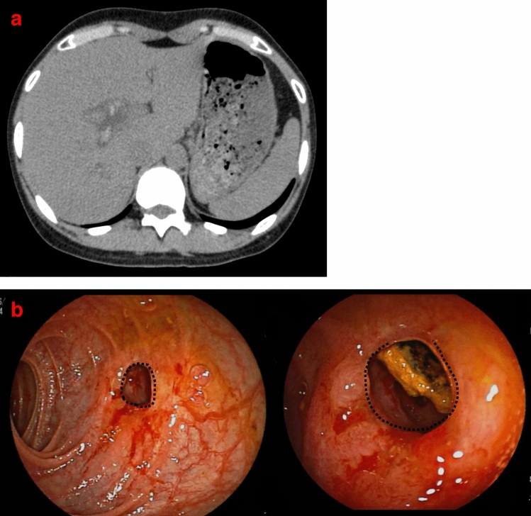 Case 3 from Table 4. (a) Stones are identified on computed tomography twelve years after radical surgery. (b) An anastomotic stricture was identified using DBERC. (dotted line) Balloon dilation and lithectomy were performed. DBERC double-balloon endoscopic retrograde cholangiography.