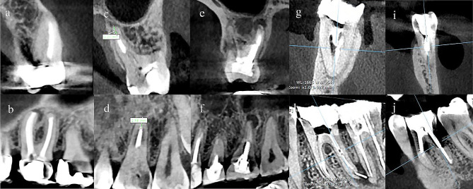 (a, c, e, g, and i): Coronal view of the teeth, (b, d, f, h, and j): Sagittal view of the teeth. (a, b): Upper left first molar with missed MB2 canal, PL, and a PFM crown; (c, d): Upper left first molar with a underfilled palatal canal; (e, f): Upper right first molar with a screw in the palatal canal, PL, and composite restoration; (g, h): Lower right first molar with separated instrument in the distal canal and PL; (i, j); Lower left first molar with furcal lesion (excluded from the study)