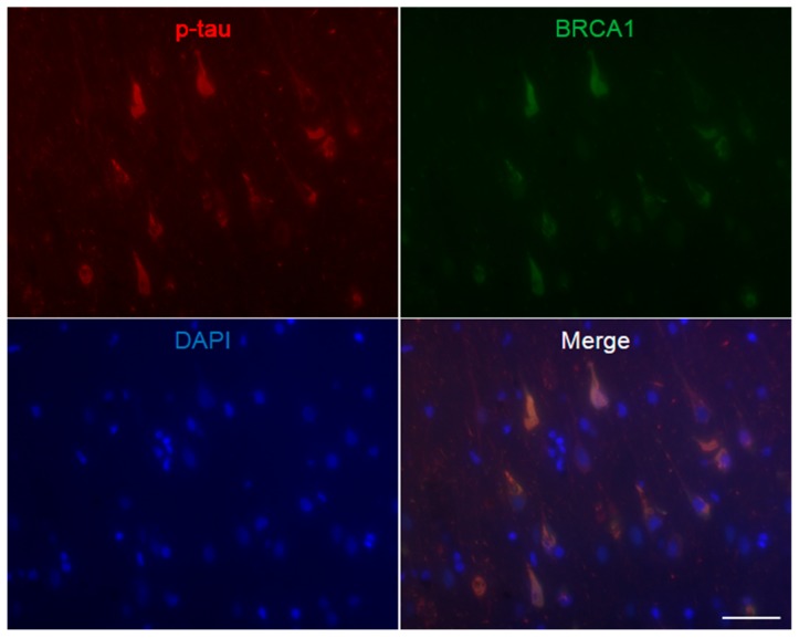 Immunofluorescence double staining of Alzheimer’s disease hippocampus. Abundant p-tau positive neurofibrillary tangles are seen, which all show colocalization of BRCA1. The scale bar represents 50 µm.