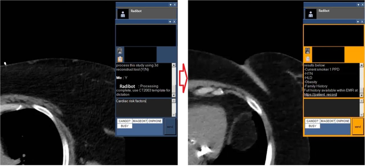Capture from Video 2 highlighting radiologist query and Radibot response