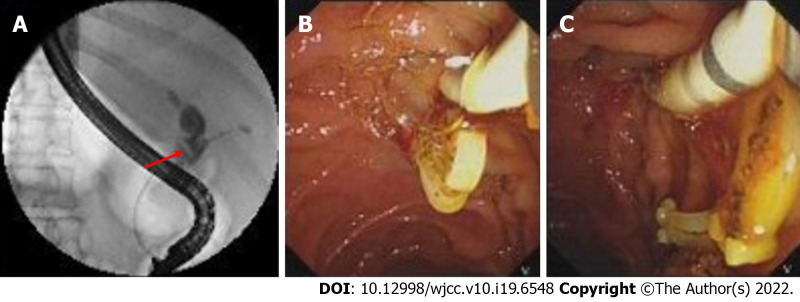 Migrated Hem-o-lok clips were detected and removed by endoscopic retrograde cholangiopancreatography. A: Endoscopic retrograde cholangiopancreatography (ERCP) showed the filling-defect in the common bile duct corresponding to the migrated Hem-o-lok clips (red arrow); B and C: Hem-o-lok clips were removed by stone basket by ERCP.