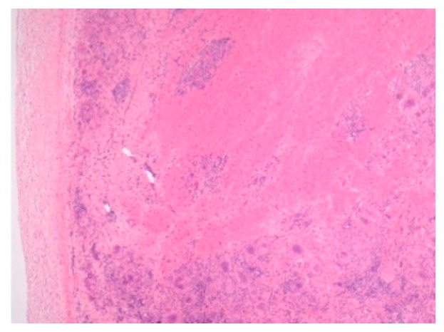 Cardiac sarcoidosis. H&E Magnification 50×.
