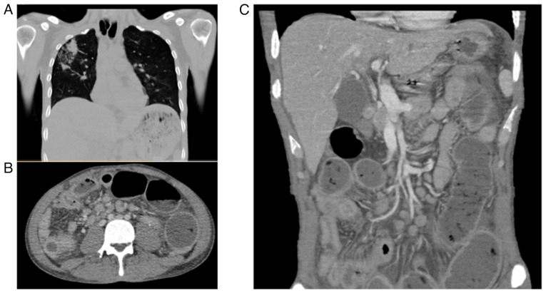 Non-contrast CT scan of the chest and abdomen: (A) Chest CT illustrating a cavitary lesion in the right upper lobe with central consolidation, intralesional air, multiple areas of increased attenuation and regions of ground-glass opacity with heterogeneous distribution, findings consistent with active pulmonary tuberculosis. (B) Axial CT scan demonstrating marked mural thickening and luminal narrowing of small bowel loops, with adjacent mesenteric fat stranding suggestive of active inflammation. Multiple enlarged mesenteric lymph nodes with a hypodense center (characteristic of caseating necrosis) are visualized, consistent with tuberculous lymphadenitis. (C) Coronal abdominal CT scan illustrating multiple dilated small bowel loops with heterogeneous wall thickening, suggestive of inflammatory or infectious involvement. Notably, there is the presence of free intraperitoneal air adjacent to the left flank, indicative of a perforated viscus. Several mesenteric lymph nodes appear enlarged, consistent with reactive or granulomatous lymphadenopathy. These radiologic features are consistent with advanced abdominal tuberculosis complicated by intestinal perforation. CT, computed tomography.