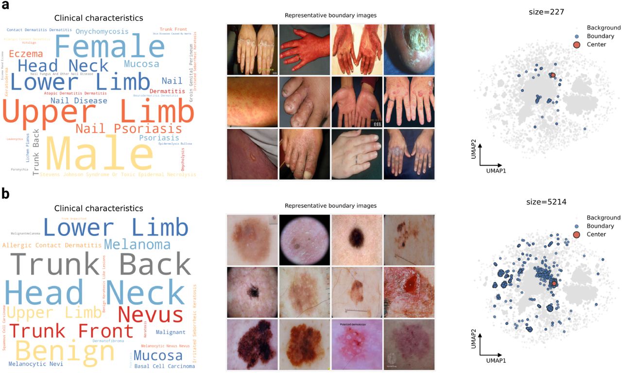 Detection of topological holes in the embedding space.a, Detailed analysis of the highest-persistence void. The word cloud of metadata from boundary samples is dominated by nail, nail disease, and nail psoriasis, confirming that this topological void represents a structural absence of nail pathologies. b, Analysis of a second void bordered by diverse dermoscopy images of the lower limb, head, and neck. The existence of this gap indicates a structural lack of varying conditions and intermediate presentations within this modality in the current archive.