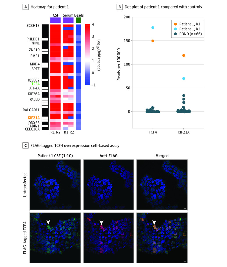 Anti–SARS-CoV-2 and Autoantibody ProfilingA, Heatmap of human phage display immunoprecipitation sequencing data for patient 1’s cerebrospinal fluid (CSF) and serum. TCF4 and KIF21A are highlighted in green and orange, respectively. Values represent log10(fold change) relative to the mean reads per 100 000 for bead controls. The black and white barcode on the left indicates rows of individual peptides that correspond to a given protein. B, Dot plot of patient 1’s CSF TCF4 and KIF21A peptide human phage display immunoprecipitation sequencing read counts compared with CSF from 66 pediatric patients with other neurologic diseases (POND). C, HEK 293 cell overexpression cell-based assay. Untransfected cells or cells transfected with FLAG-tagged TCF4 were immunostained with CSF (1:10) and a rabbit anti-FLAG antibody. Cells were then counterstained with anti–human IgG 488 (green) and anti–rabbit IgG 594 (red). Arrowheads indicate an example of a TCF4-overexpressing cell that was immunostained by CSF IgG. Scale bars are 10 μM. R1 and R2 indicate technical replicates 1 and 2, respectively.